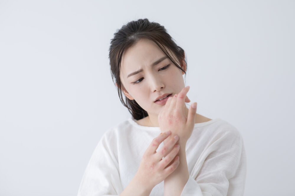 アレルギー反応で手に湿疹ができる女性