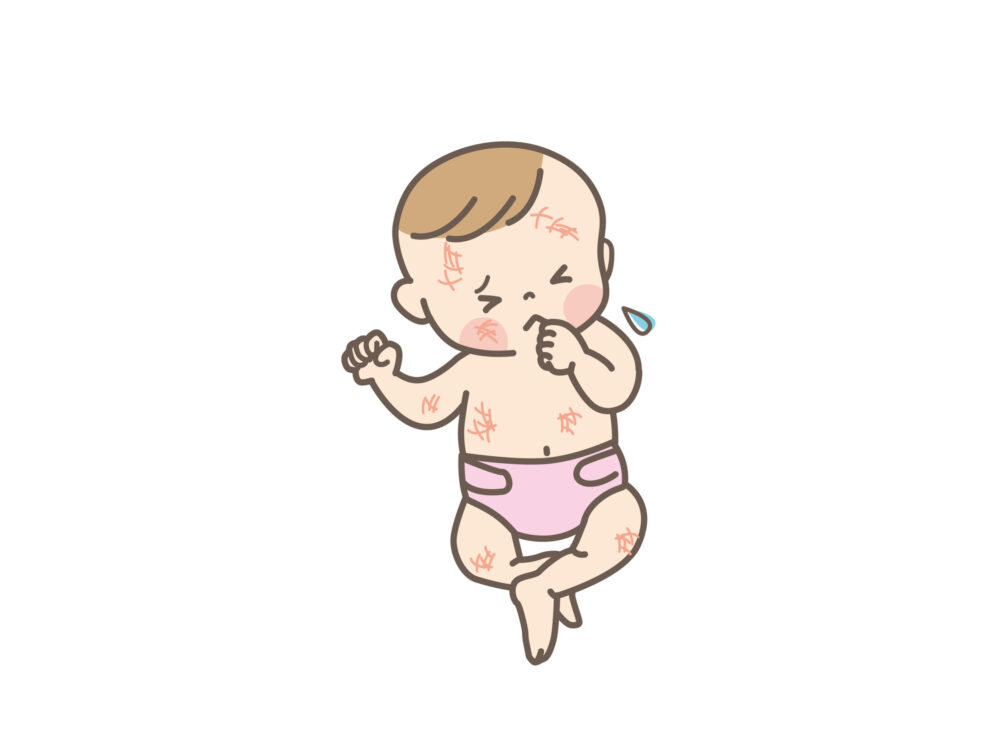かゆみで全身をかきむしり、赤みや引っかき傷が見られる赤ちゃんのイメージ